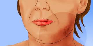 ВЪЛЧАНКА (ЛУПУС): ЗА РИБАТА И ХРАНИТЕЛНИТЕ АЛЕРГИИ